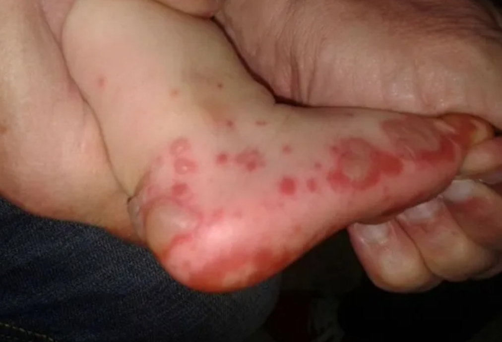 Virus “manos, pie y boca”: se detectaron varios casos en Pocito
