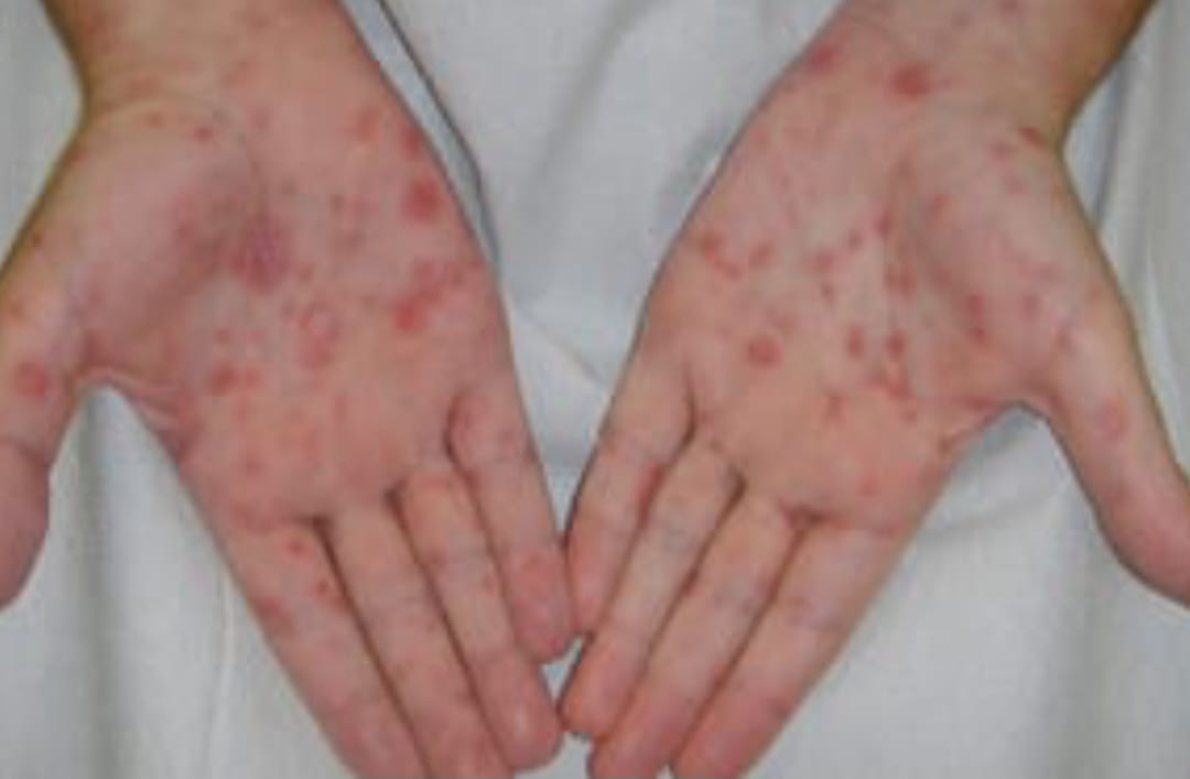 Aumentan los casos de sífilis en Argentina y preocupa el avance de la infección