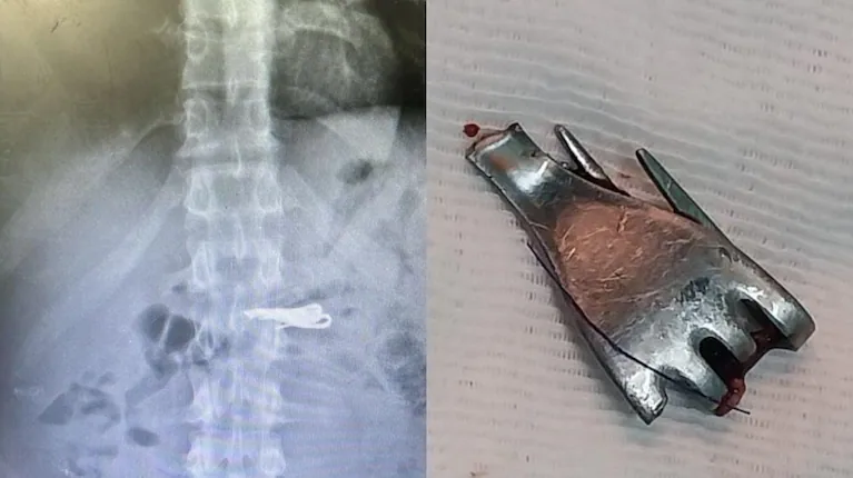 Un preso de alto perfil terminó hospitalizado en Santa Fe después de tragarse un tenedor