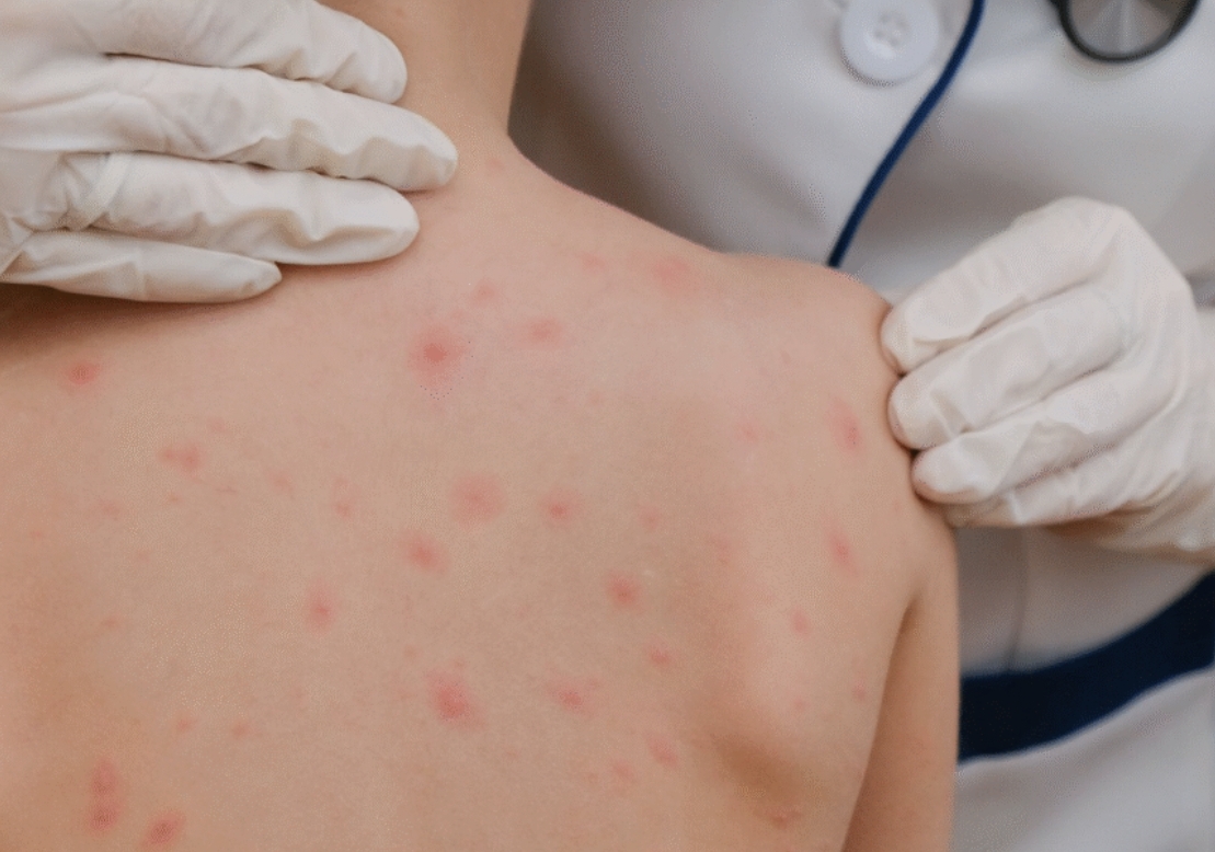 Sarampión: se confirmó el primer caso del año en Argentina