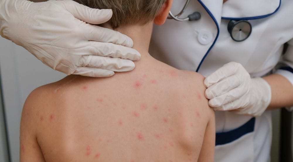 Siete casos de varicela en una escuela de Caucete: protocolos activados y recomendaciones para prevenir contagios