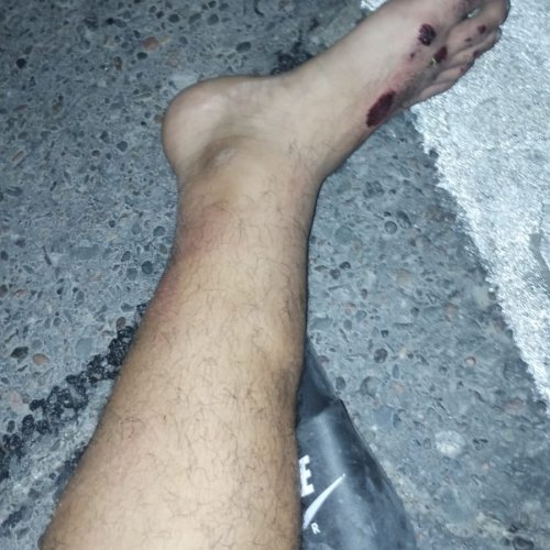 Accidente en Rincón Cercado fue atropellado por detrás y esta internado con varias lesiones