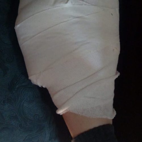 Feroz ataque de perros a una vecina de 9 de julio le hicieron mas de 10 puntos en la pierna