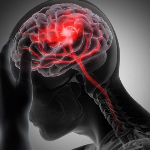 Salud informa los factores para reconocer a tiempo un ACV