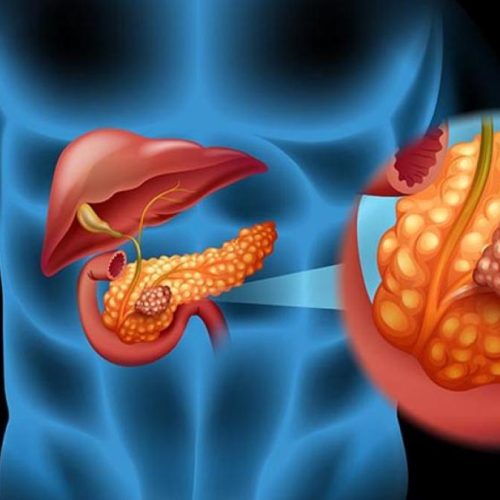 Científicos argentinos y españoles identifican una proteína clave en la lucha contra el cáncer de páncreas