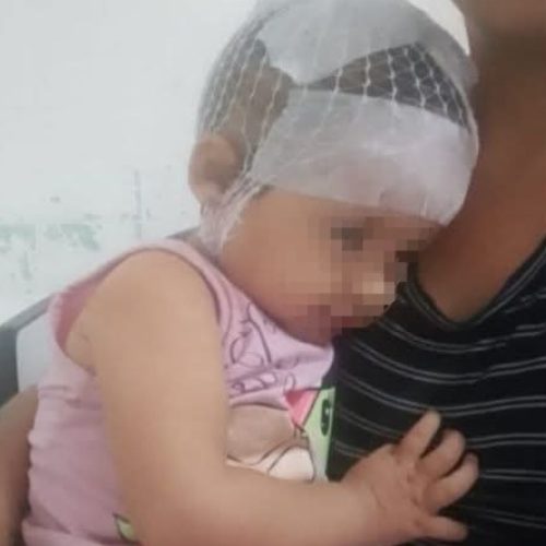Piden colaboración para una nena que cayó a las brasas y se quemó la cabeza