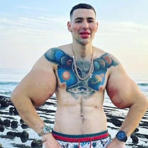 El “Popeye ruso”: se inyectó vaselina en los bíceps y ahora arriesga perder ambos brazos