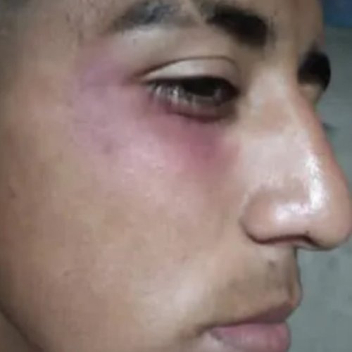 Un jugador fue herido por pirotecnia lanzada desde la tribuna en pleno partido