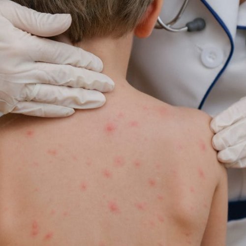 Siete casos de varicela en una escuela de Caucete: protocolos activados y recomendaciones para prevenir contagios