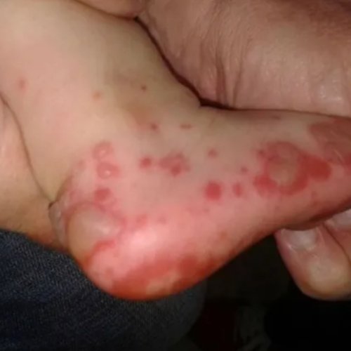 Virus “manos, pie y boca”: se detectaron varios casos en Pocito