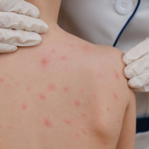 Sarampión: se confirmó el primer caso del año en Argentina