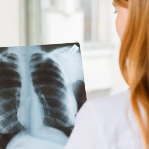 Día de la Tuberculosis: Salud organiza actividades de promoción y prevención