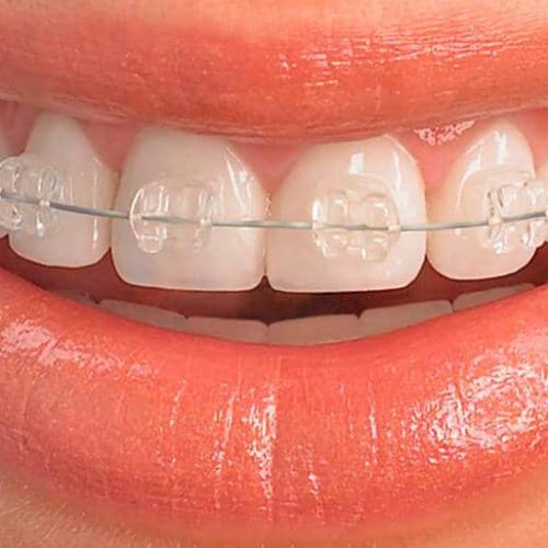 Atención 25 de Mayo, 9 de Julio y Caucete llego la obra social que incluye los brackets como servicio esencial de Salud
